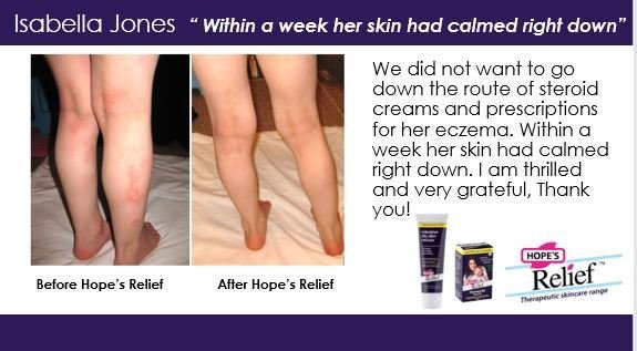 Intensive Dry Skin Rescue Cream Manuka Aloe Calendula 60g - Hopes Relief - Body Cream - Eco Natural Products