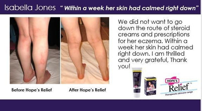 Intensive Dry Skin Rescue Cream Manuka Aloe Calendula 60g - Hopes Relief - Body Cream - Eco Natural Products