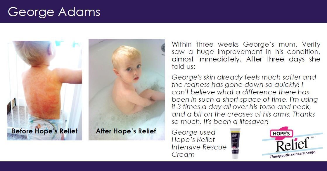 Intensive Dry Skin Rescue Cream Manuka Aloe Calendula 60g - Hopes Relief - Body Cream - Eco Natural Products