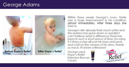 Intensive Dry Skin Rescue Cream Manuka Aloe Calendula 60g - Hopes Relief - Body Cream - Eco Natural Products